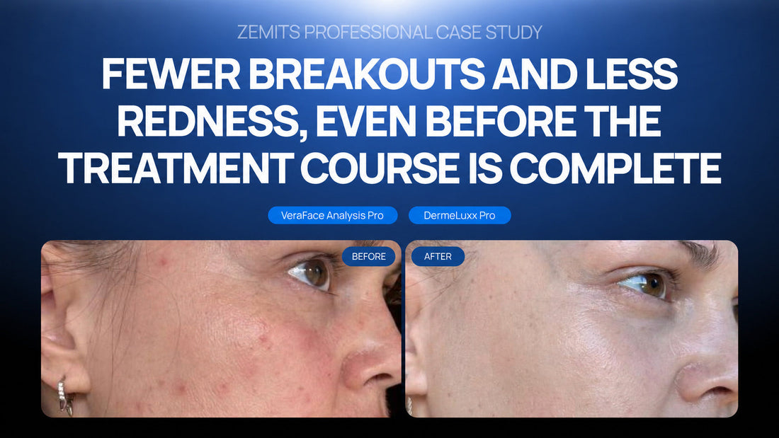 Case: Fewer breakouts and less redness, even before the treatment course is complete