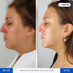 Before and after RF cryo treatment results Zemits FrioLift